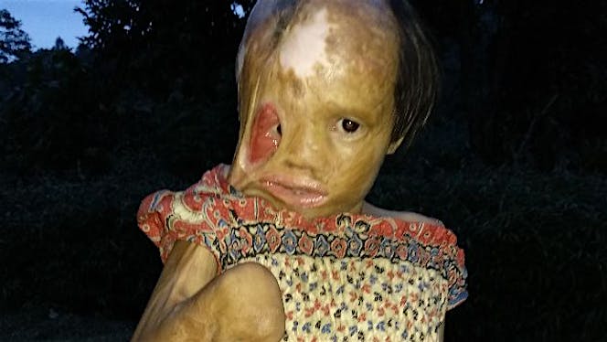 Bantu Elizabeth Operasi Bedah Pasca Luka Bakar