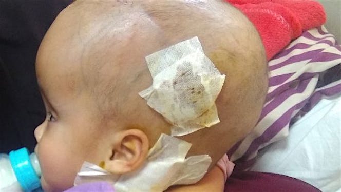 Bantu Fatih sembuh dari hydrocafalus