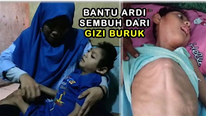 Bantu Ardi Sembuh Dari Gizi Buruk