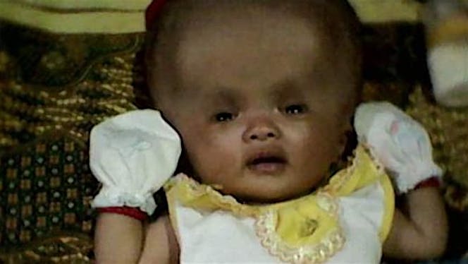 Bantu Sofia Dila dari Hydrosefalus