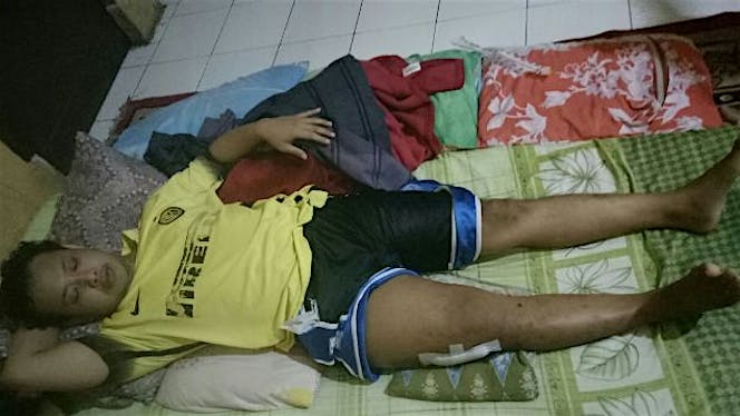 Ustad Hilman cangkok tulang buatan
