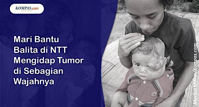 Bantu Balita Mengidap Tumor di Sebagian Wajahnya
