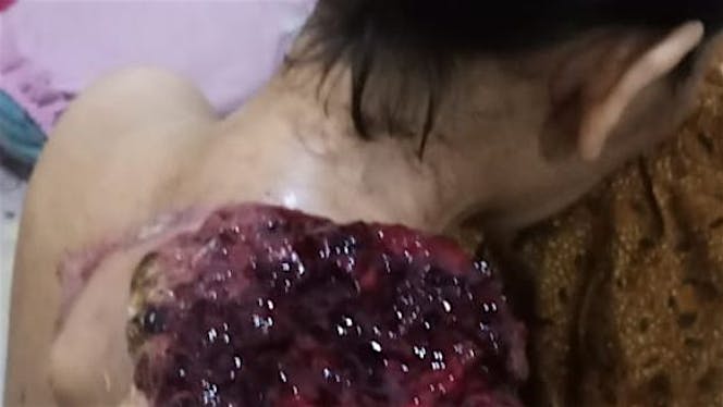 Bantu Nur Hikmah operasi kanker pembuluh darah