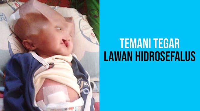Bantu Tegar melawan penyakit Hidrosefalus