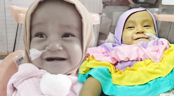 Bantu Alula Sembuh dari Atresia Bilier