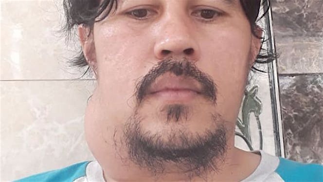 Bantu Jevi sembuh dari kelenjar getah bening