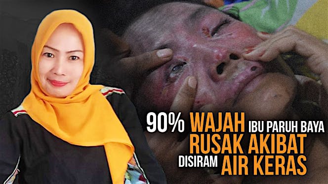 Operasi Untuk Bu Merry Yang Disiram Air Keras