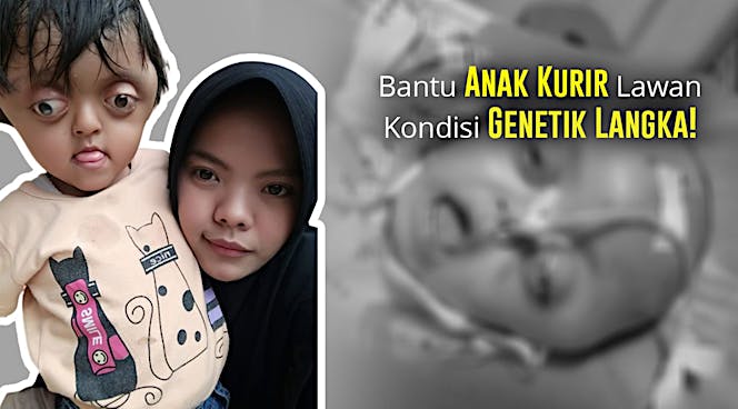 Bantu Alesha Berjuang Lawan Crouzon Syndrome