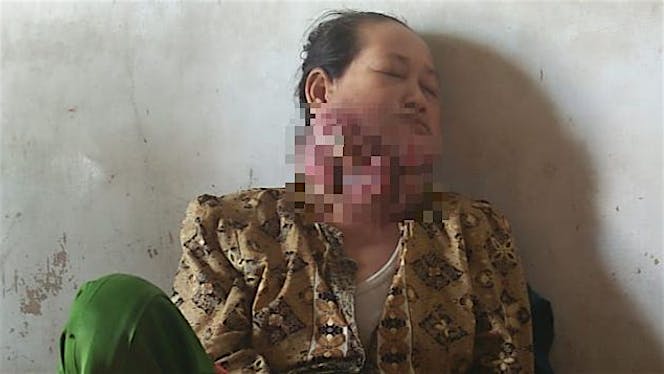 Selamatkan bi ijah dari tumor ganas