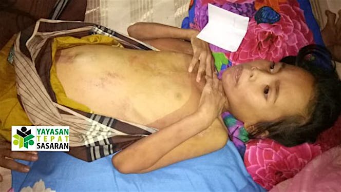 Bantu Hasri Muliani untuk sembuh