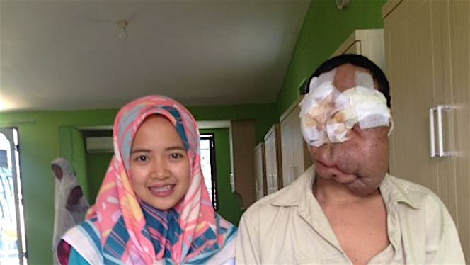 Bantu apipudin oprasi tumor wajah