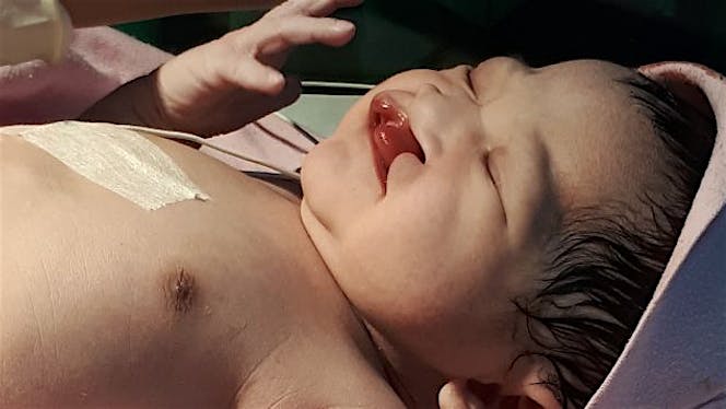 Bantu Nafeezha untuk Operasi bibir sumbing