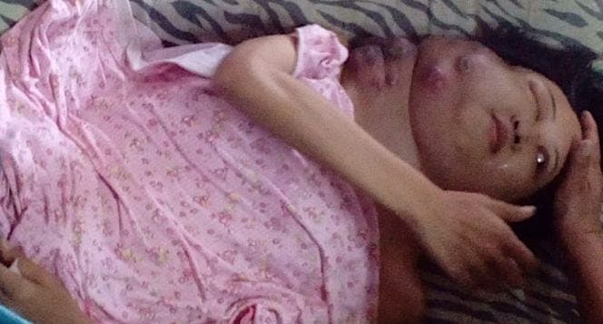 Donasi untuk Anita pejuang Cancer Nasofaring