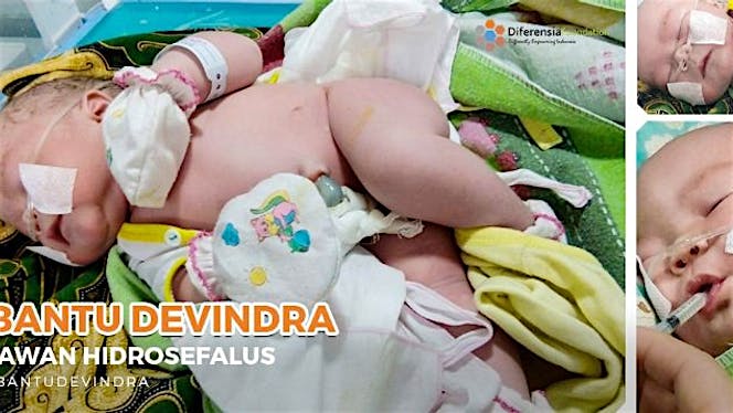 Bantu Baby Devindra Hidup Lebih Lama