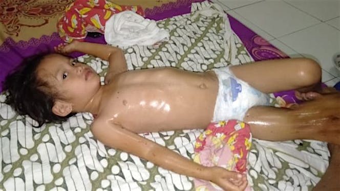 BANTU AQILA MELAWAN PENYAKIT KEBOCORAN JANTUNG