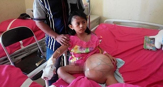Bantu Nissa (6) Sembuh dari Kanker Tulang