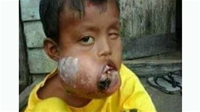 Bantu Aldi melawan Tumor