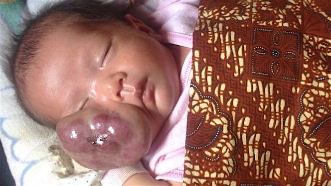 Bantu adek khairul anwar pengidap tumor dipipi
