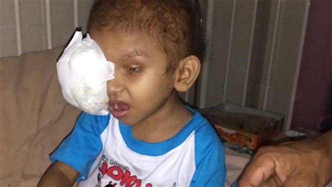 Bantu Aulia Sembuh Dari Retinoblastoma