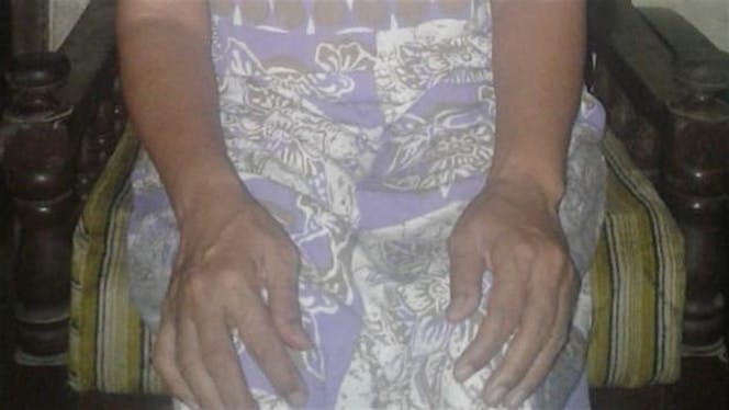 Bantu Ibuku melawan Parkinson