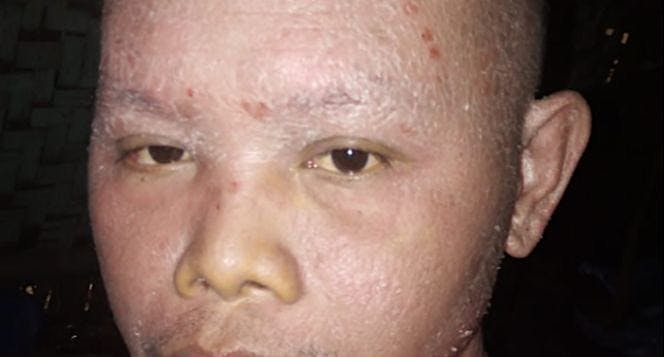 Kulit gatal dan melepuh