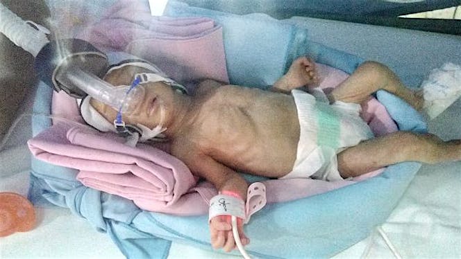 Bantu Vondra Si Pejuang NICU