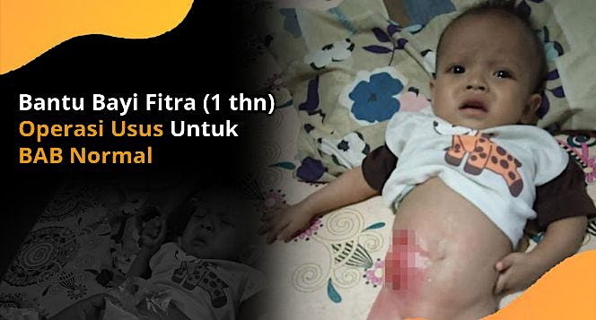 Bantu Bayi Fitra Operasi Usus