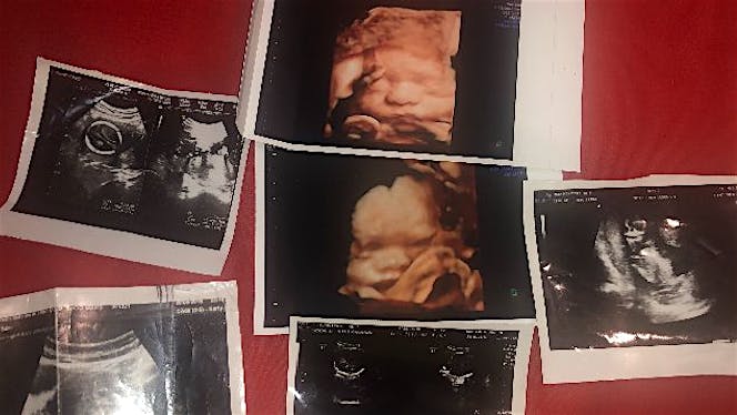 bantu biaya persalinan baby EL