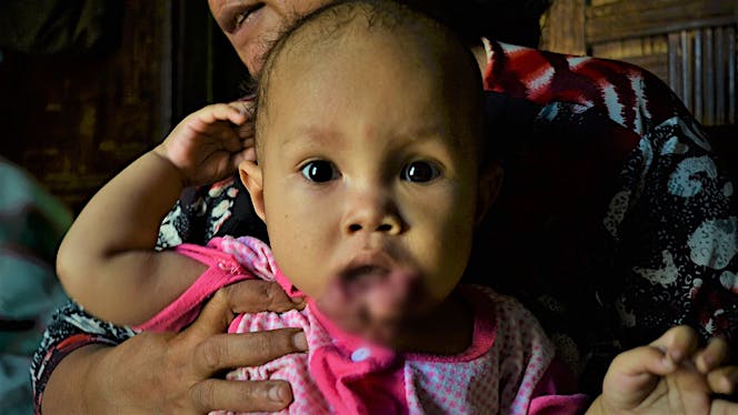 Yuk, Bantu Fadila Sembuh Dari Tumor Mulut!