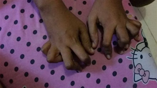 Bantu Menuk biaya transport terapi jari tangan