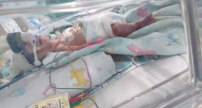 Bantu Jacob, prematur 7 bln, organ belum sempurna