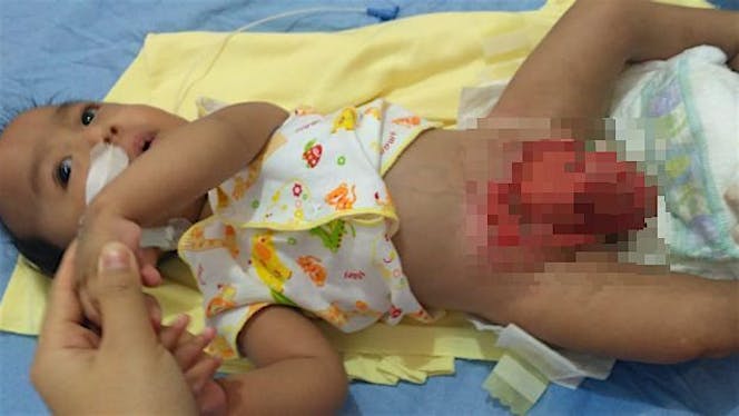 Bantu Akhtar Sembuh dari Ekstrofi Kloaka