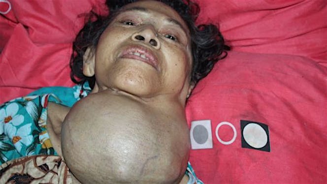 Bantu Mbah Sukaria Melawan Kanker di Leher