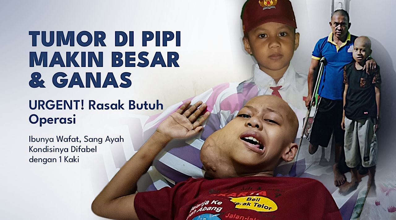 Anak Piatu Tumor Ganas Di Pipi Rasak Butuh Operasi