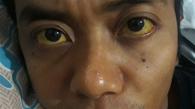 Bantu driverojol operasi penyumbatan saluran emped