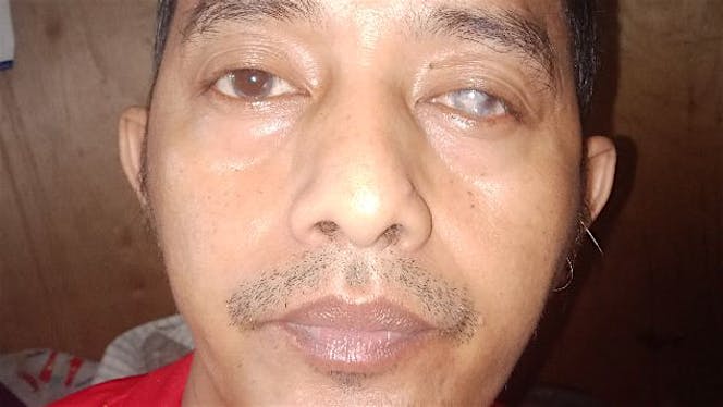 bantu ayah juanda mengganti kornea mata