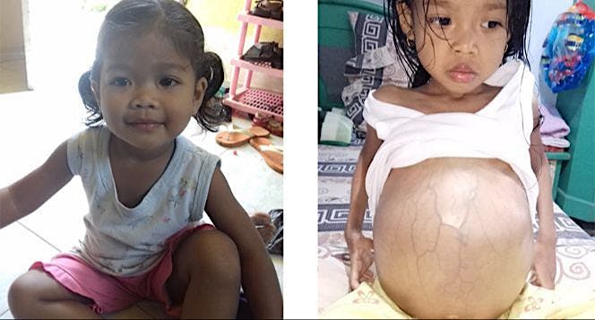 Mari Bantu Andiny Alzahra Sembuh dari Tumor Ginjal