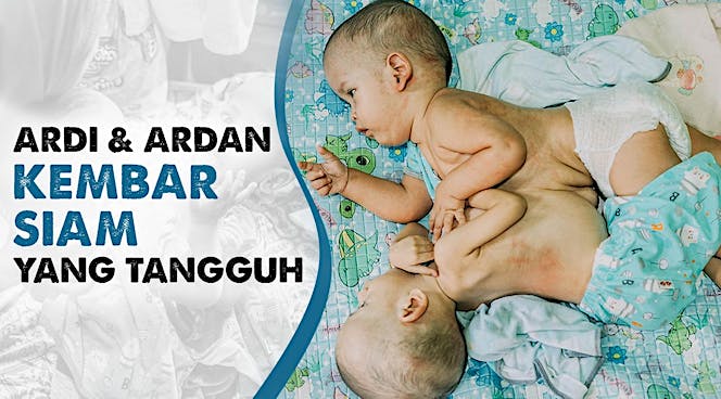 Ardi & Ardan, Hidup Dengan Organ Hati Menempel