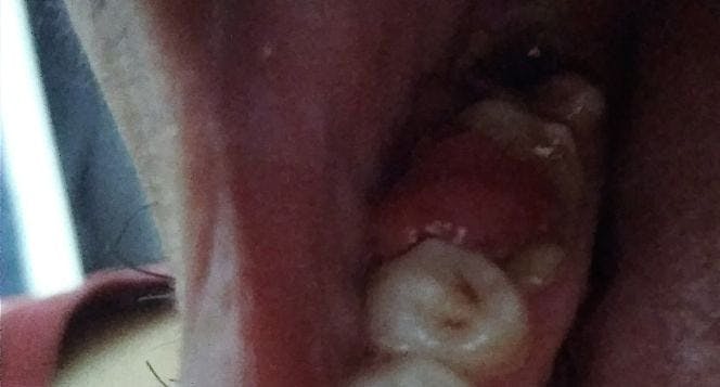 Bantu Saya Untuk Operasi Polip Pulpa Bantu Saya Untuk Operasi Polip Pulpa