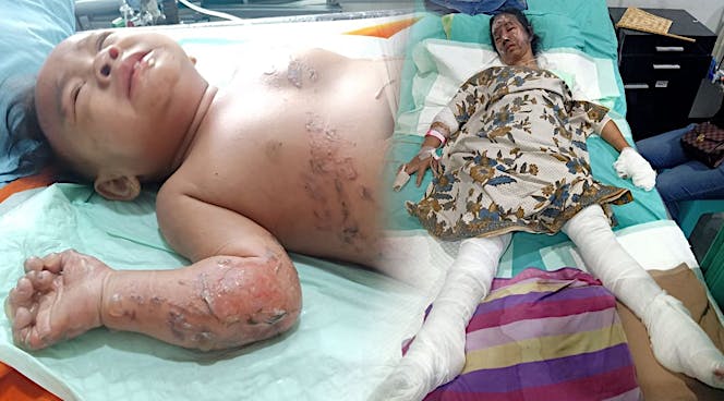Bantu wati dan bayinya sembuh dari luka bakar