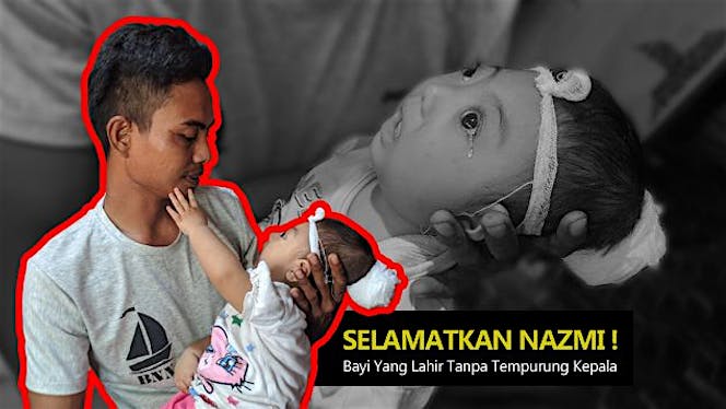 Selamatkan Nazmi ! Lahir Tanpa Tempurung Kepala