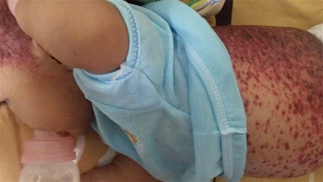 Bantu kiya melawan leukimia limfoblastik akut