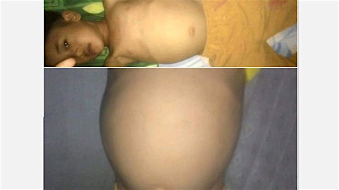 Bantu Riki melawan Tumor Intra abdomen