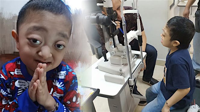 Bantu Alvaro Operasi Kraniofasial