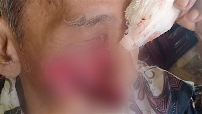 Bantu kakek Alfian melawan Kanker Melanoma