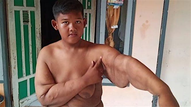 Aria Bocah Raksasa Asal Karawang Butuh Bantuan