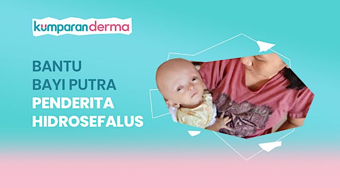 Bantu Bayi Putra Penderita Hidrosefalus