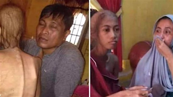 Bantu intan melawan kanker tulang