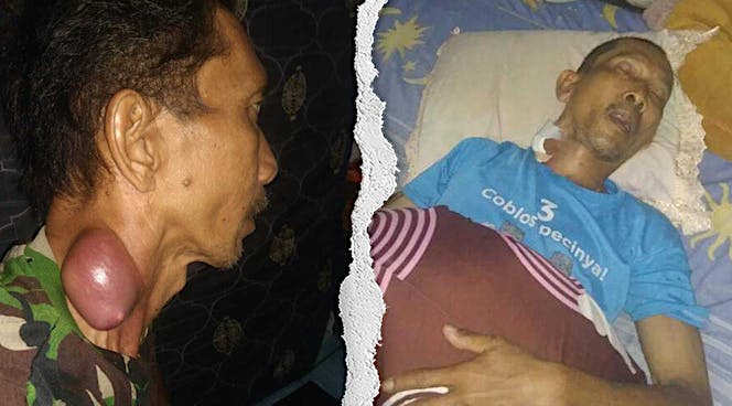 Tak Bisa Kerja Angkut Sampah Akibat Tumor Lidah!