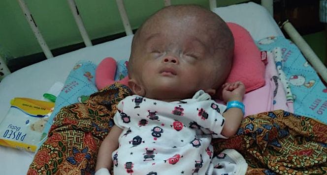 Bantu Balita Azka sembuh dari Hidrosefalus